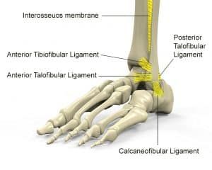 Sprain Of Calcaneofibular Ligament
